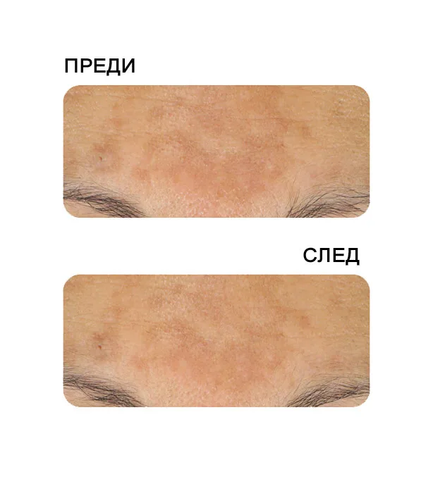 ANTI SPOT